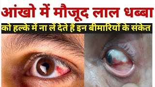 आंख लाल होने का कारण  subconjunctival hemorrhage in hindi  subconjunctival hemorrhage treatment [upl. by Nayek]