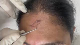 Right and easy way of suture removal [upl. by Musa]