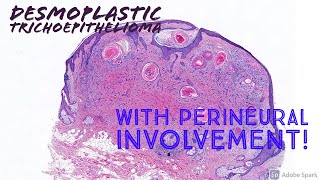 Desmoplastic Trichoepithelioma with perineural involvement [upl. by Rramaj]