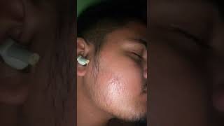 My Minoxidil Journey Shocking Result In 3 Months 😱😳 ytshorts shorts [upl. by Hutson]