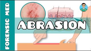 Abrasion  What are the causes of abrasion  What are types of abrasion [upl. by Drolet]