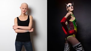 Genetic Disorder Sufferer Defies Critics To Become International Model [upl. by Jeggar]