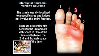 Interdigital Neuroma Mortons Neuroma  Everything You Need To Know  Dr Nabil Ebraheim [upl. by Htebazila]