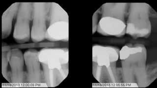 Tips and Tricks for Bitewing XRays [upl. by Eiuol]