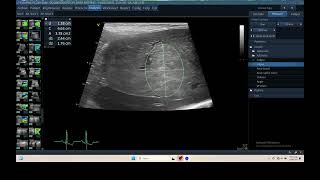 IQ 306 LIVER HEPATOMA ULTRASOUND ECHOPAC ANALYSIS [upl. by Goldi]