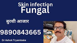 skin infection fungal Dr Ashok Tryambake 9890843665 [upl. by Etnaihc570]