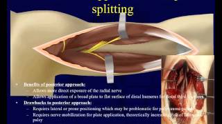 Humeral Shaft Fractures 2  Surgical techniques OTA lecture series III u04b [upl. by Ashlee]