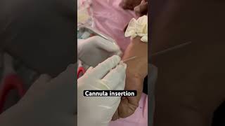 Cannula insertion 👍 shorts hospital cannula injection trending aiims doctor [upl. by Leiser939]