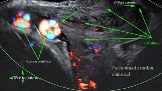 Procubitus du cordon ombilical cordon ombilical praevia  37 SA [upl. by Gross739]