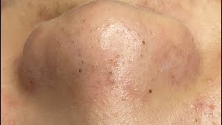 Blackheads on Nose  Acne treatment LyLy Beauty Spa 24 2024 [upl. by Caines]