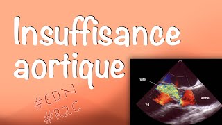 Insuffisance aortique  Valvulopathies cardiaques item 233 des EDN [upl. by Sonni]