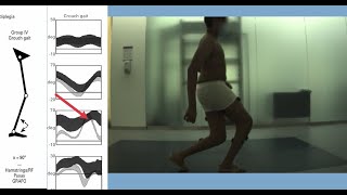 Gait Analysis Patterns in Diplegic Cerebral Palsy [upl. by Latashia]