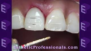 Porcelain Veneers Preparation Techniques 1 [upl. by Nirrak]