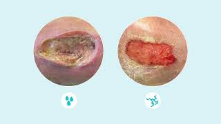 How to assess wound exudate [upl. by Jared]