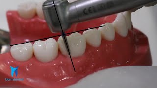 TOOTH PREPARATION FOR ZIRCONIA CROWN [upl. by Housen717]