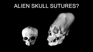 Science VS the Aliens of Peru Episode 4 Skull sutures and parietal foramen [upl. by Bridget]