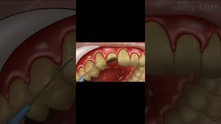 Tooth extraction animationdental implant surgerytreatmentanimation animation asmrvideo asmr [upl. by Gibson]