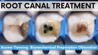 Root Canal Treatment🔵Mandibular 2nd Molar🟡Access Opening🟢 Biomechanical Preparation⚪️Obturation [upl. by Dee Dee688]