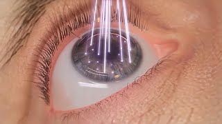 How Laser Eye Surgery Lasik is Performed  3D Animation UrduHindi [upl. by Zahavi227]