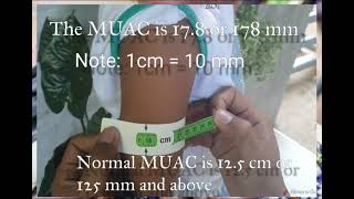 IMCI Measuring Mid Upper Arm Circumference MUAC [upl. by Itram]