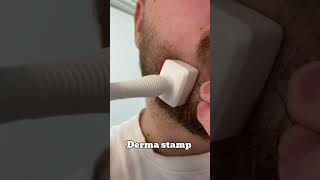 This Is How I Grew A Beard Using Minoxidil And A Derma Stamp [upl. by Ennasor223]