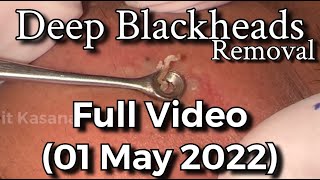 Deep Blackheads Removal with Cotton Bud amp Extractor Full Video By DrLalit Kasana [upl. by Acisset]