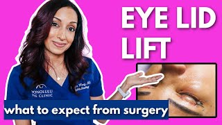 Upper Eyelid Surgery Blepharoplasty What To Know [upl. by Yenoh895]