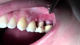 Crown Lengthening 13 Before amp Immediate Post op [upl. by Mat]