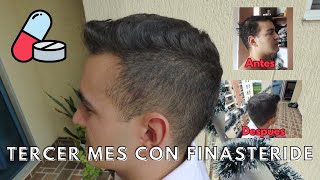 TERCER MES con FINASTERIDE 💊 [upl. by Harle]