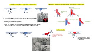 Isolated ostial LAD or ostial LCx stenting [upl. by Emma]