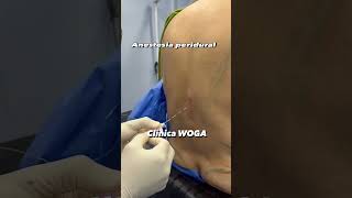 Anestesia en abdominoplastia con lipoescultura anestesiaperidural anestesia [upl. by Aracal]