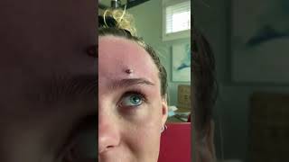 Cystic Acne Extractions Whiteheads  Blackheads Removal Today [upl. by Ahsienahs]