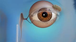 US Ophthalmic Oculoplastics Endoscopic DCR [upl. by Ytirahc]