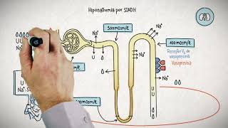 HIPONATREMIA Y SU TRATAMIENTO [upl. by Glantz498]