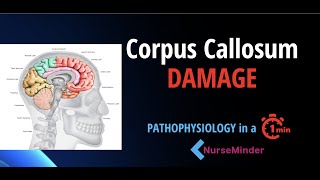 Pathophysiology for Nursing Corpus Callosum and the Nervous System [upl. by Melisse]