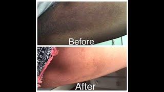 Get rid of dark inner thighs in just 5 days very easy home remedy homeremedy darkinnerthighs [upl. by Kcirdlek]