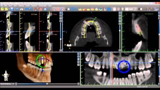 Blue Sky Plan 3 Tutorial Placing Implants [upl. by Ettenig8]