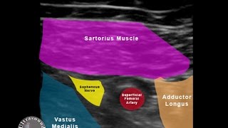 adductor canal block URG [upl. by Sekoorb]