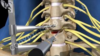 Anterior Cervical Fusion C6 C7 [upl. by Dwan]