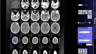 CT Scan of Brain flimingSIEMENS [upl. by Northey]