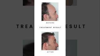 PRP Hair Treatment  prp hair loss treatment before and after  hairloss treatment prpforhairloss [upl. by Naliorf]