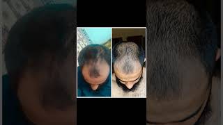 Day1 and day 50 minoxidil hairstyle hairgrowth hairtransformation hairtransplant hairtreatment [upl. by Hanimay]