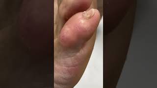 Watch how this Aussie podiatrist expertly removes a little toe callus ToeCallusRemoval FootHealth [upl. by Yezdnil]