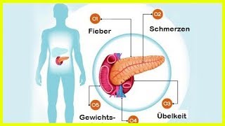 6 Symptome bei Erkrankungen der Bauchspeicheldrüse [upl. by Shari]