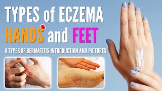 Types of Eczema on Hands and Feet  Hands and Feet Dermatitis Types with Pictures [upl. by Moseley460]