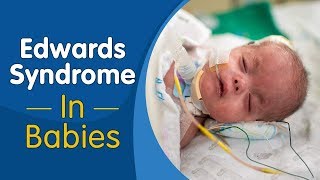 Edwards Syndrome in Babies [upl. by Nilatak877]