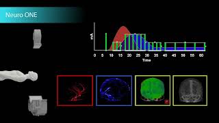 Complete Brain Perfusion Imaging in Just One Minute [upl. by Hedda600]