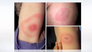 Lyme Disease Pictures  wikiSymptoms [upl. by Hutson]