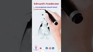 Mnemonic Edwards Syndrome neet fmge usmle biology [upl. by Niliram]