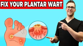 Plantar Warts Removal at Home Treatment Foot amp Toe Wart Remedies [upl. by Blus351]